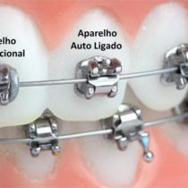 Aparelho autoligado