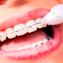 Dicas para Limpar o seu aparelho dentário