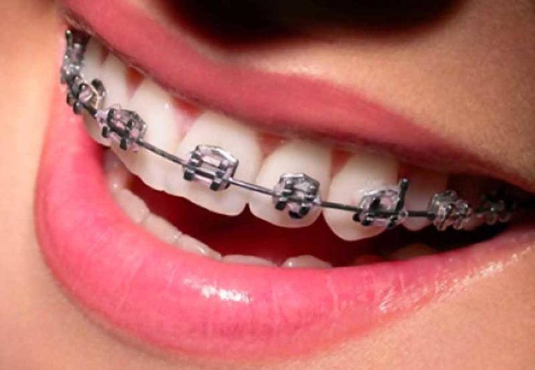 aparelho-ortodontico-siga-odontologia